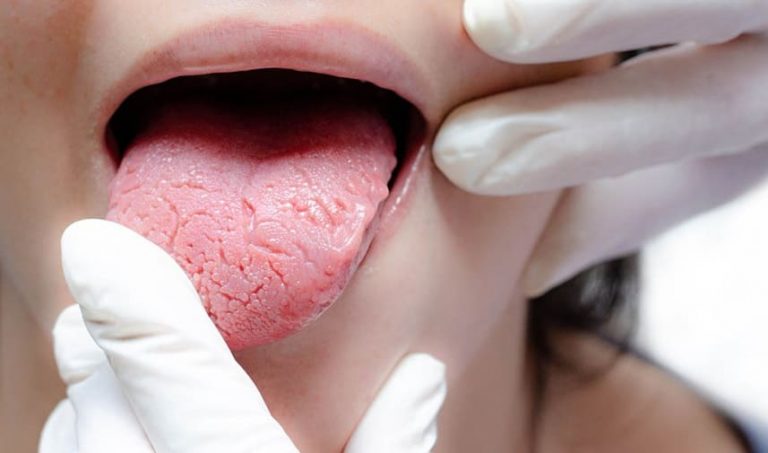 язик-при-цукровому-діабеті