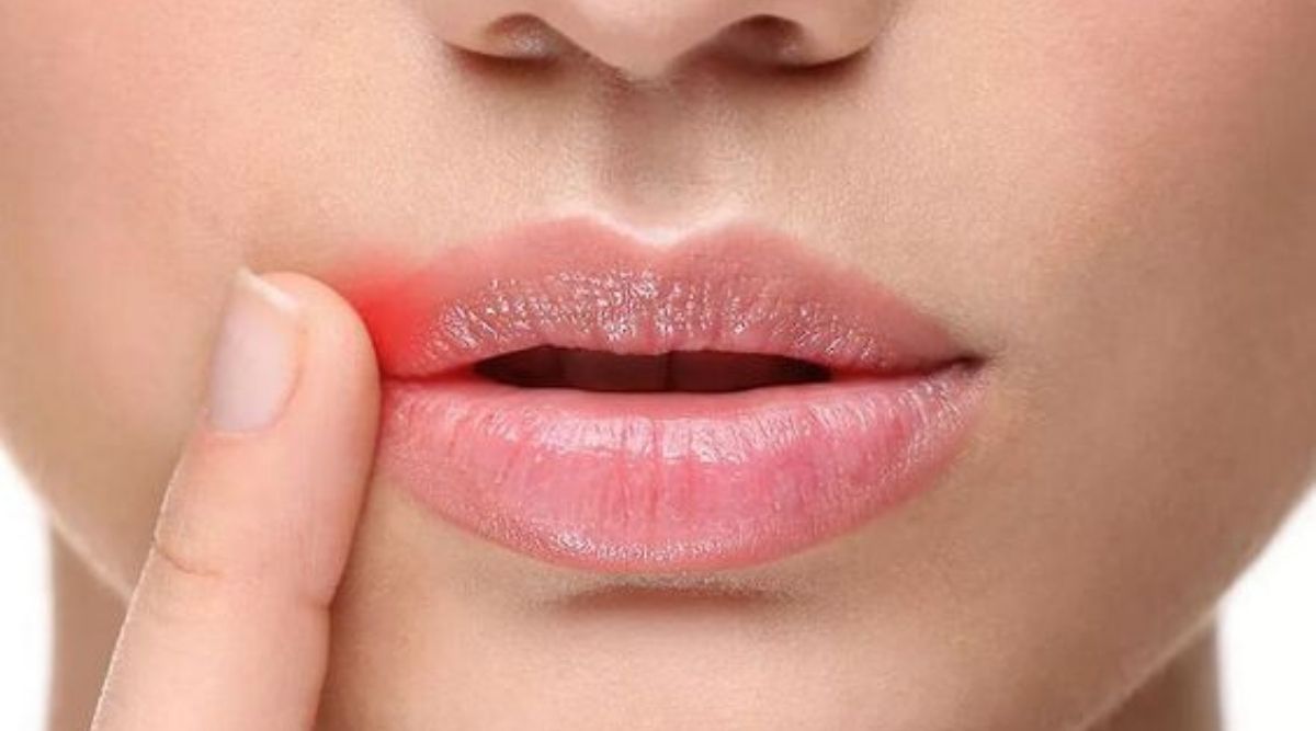 як-позбутись-заїди-за-1-день