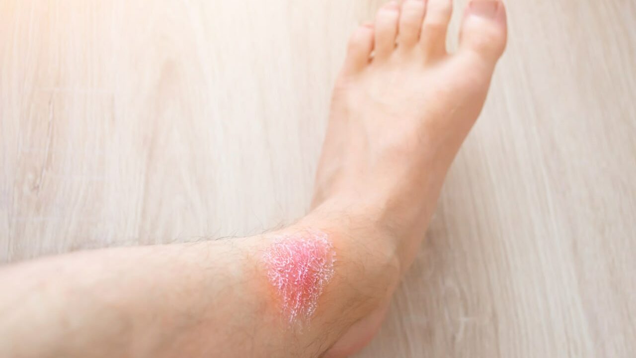 бешиха-лікування