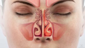 сухість-в-носі