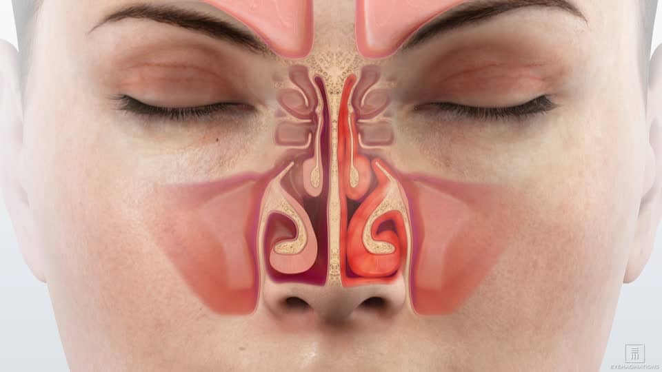 сухість-в-носі