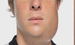 хвороба-свинка-у-чоловіків