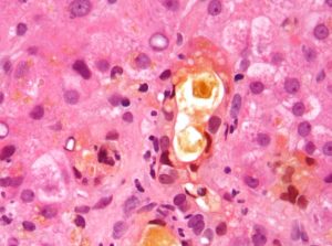 холестаз-це