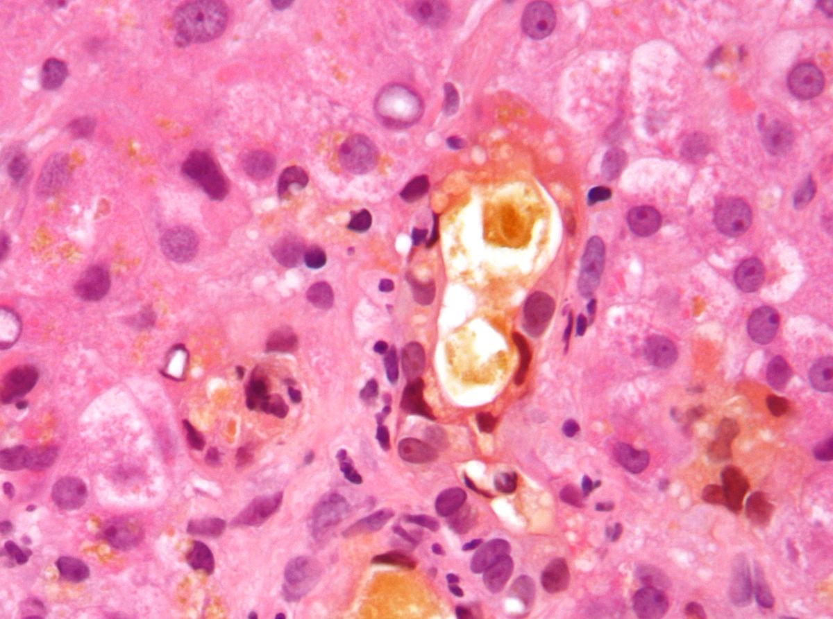 холестаз-це