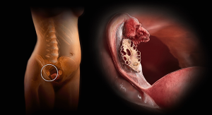 чи-можна-вилікувати-полікістоз-яєчників