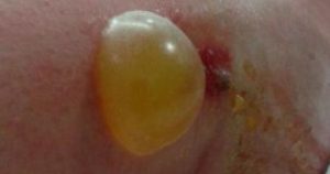 як-виглядає-укус-павука