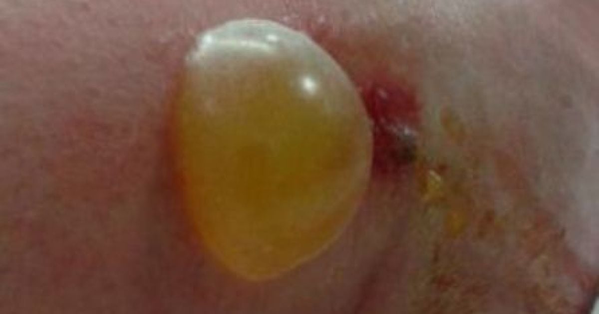 як-виглядає-укус-павука