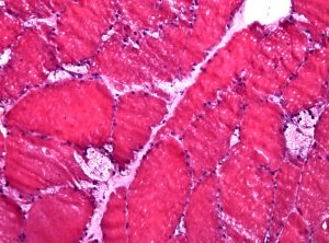 хвороба-помпе