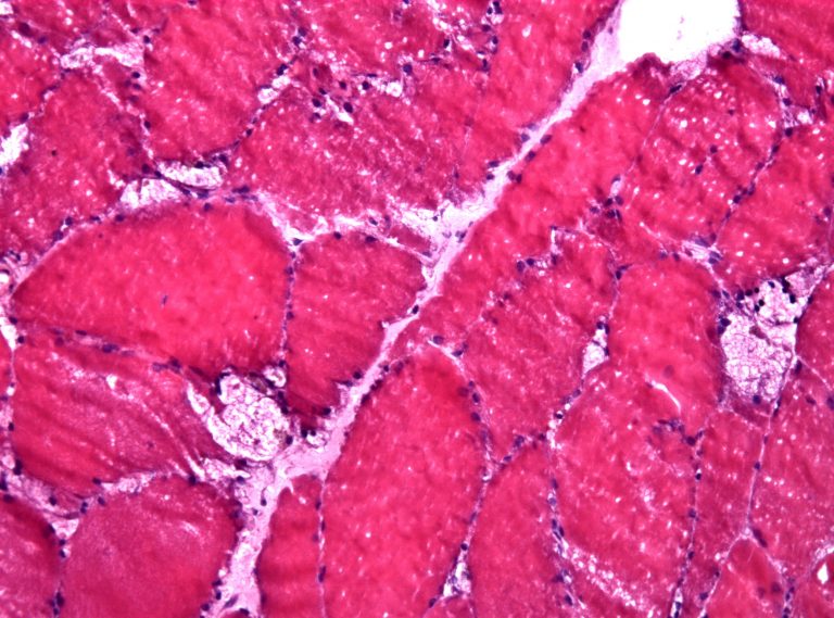 хвороба-помпе