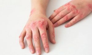 як-виглядає-екзема