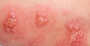 як-виглядає-оперізуючий-герпес