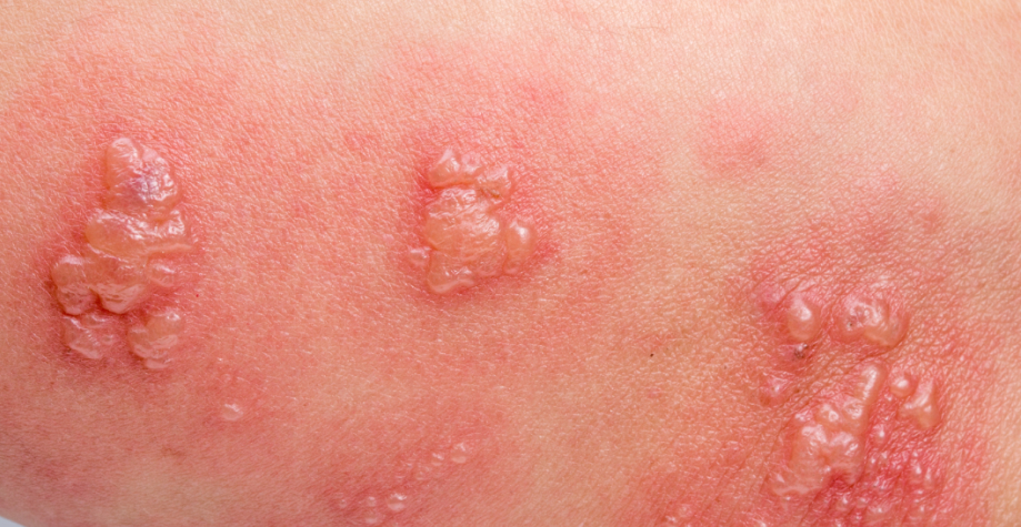 як-виглядає-оперізуючий-герпес