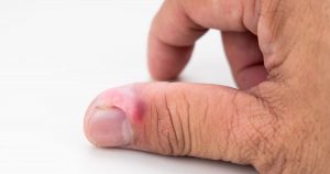 як-зняти-запалення-пальця