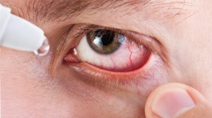 як-зняти-почервоніння-очей-в-домашніх-умовах