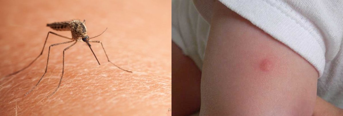 як-розпізнати-укуси-комах