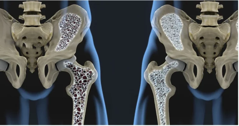 iak-likuvaty-osteoporoz-efektyvni-stratehii-na-2026-rik-8a58
