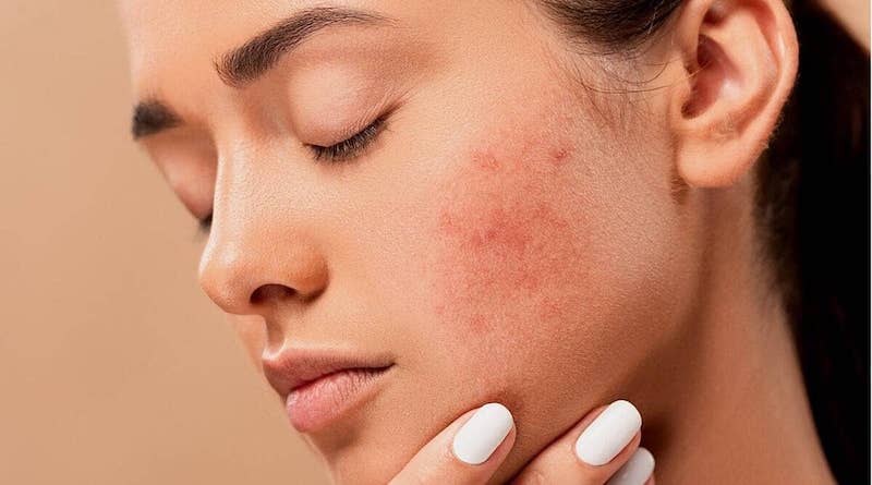 acne-5561750_1280
